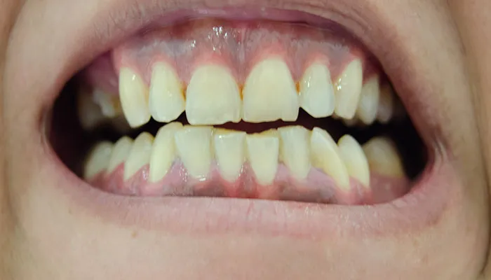 グラインディング