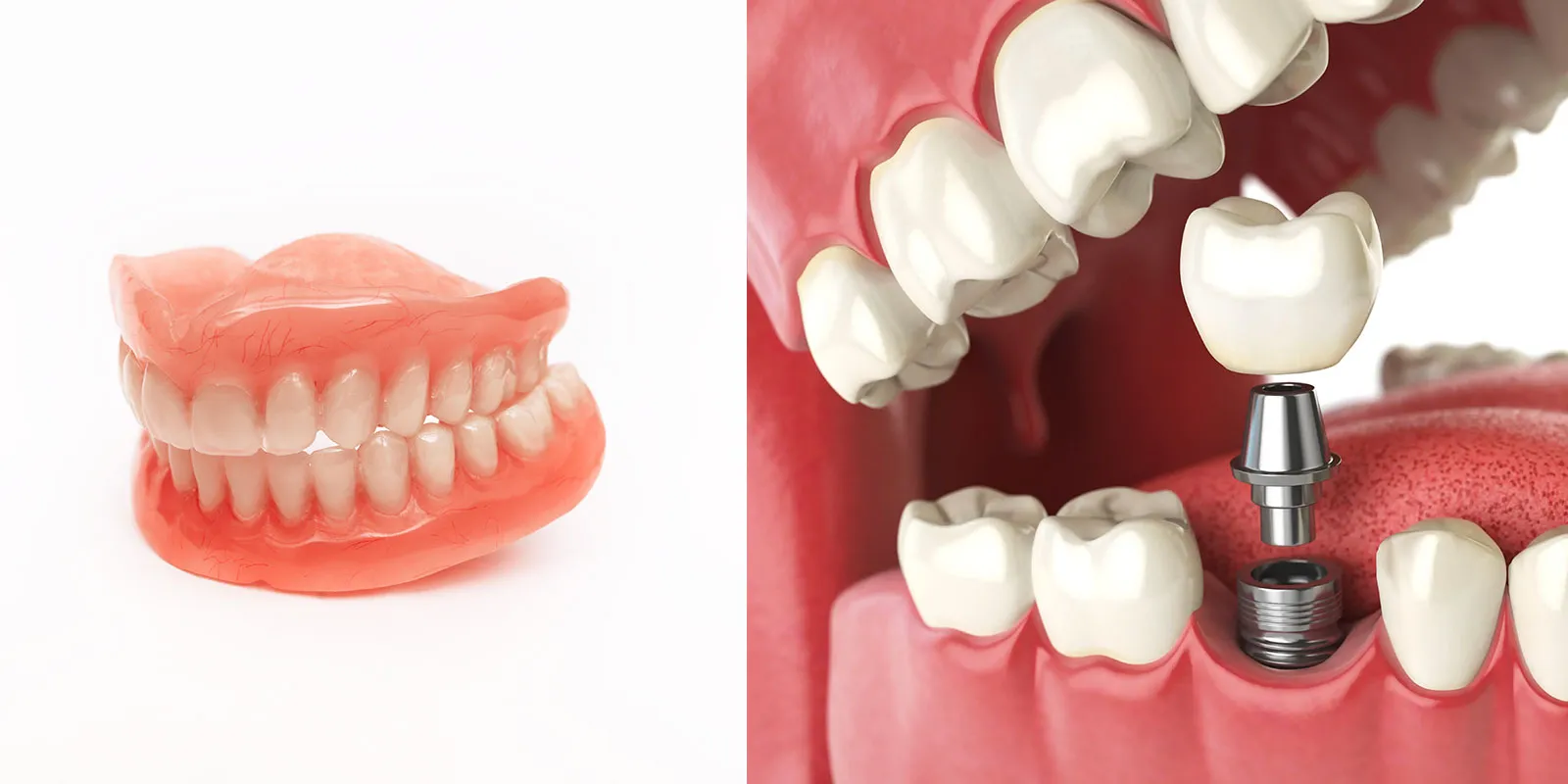 入れ歯とインプラントの違い